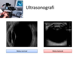 Ultrasonografi




Mata normal           Mata katarak
 