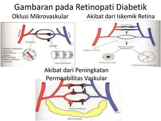 Gambaran pada Retinopati Diabetik
Oklusi Mikrovaskular      Akibat dari Iskemik Retina




           Akibat dari Peningkatan
           Permeabilitas Vaskular
 