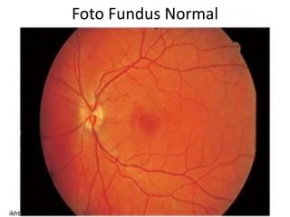 Foto Fundus Normal




ikhtisar
 