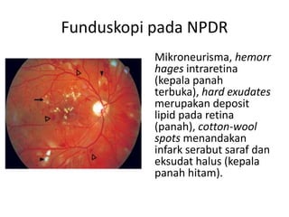 Funduskopi pada NPDR
           Mikroneurisma, hemorr
           hages intraretina
           (kepala panah
           terbuka), hard exudates
           merupakan deposit
           lipid pada retina
           (panah), cotton-wool
           spots menandakan
           infark serabut saraf dan
           eksudat halus (kepala
           panah hitam).
 