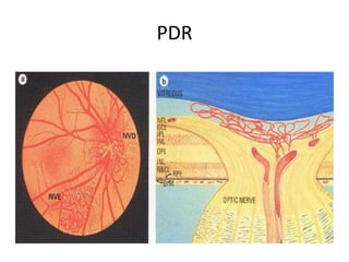 PDR
 