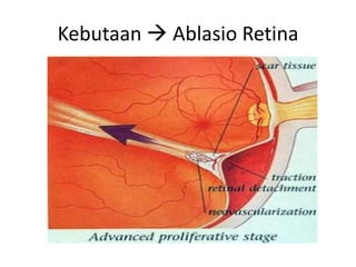 Kebutaan  Ablasio Retina
 