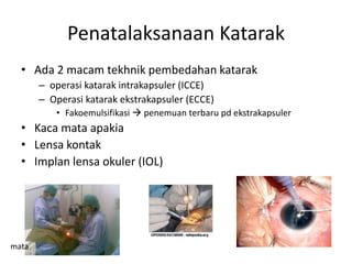Penatalaksanaan Katarak
  • Ada 2 macam tekhnik pembedahan katarak
       – operasi katarak intrakapsuler (ICCE)
       – Operasi katarak ekstrakapsuler (ECCE)
          • Fakoemulsifikasi  penemuan terbaru pd ekstrakapsuler
  • Kaca mata apakia
  • Lensa kontak
  • Implan lensa okuler (IOL)




mata
 