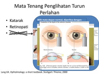 Mata Tenang Penglihatan Turun
                      Perlahan
    • Katarak                     TIO normaldepan normal, diperiksa dengan:
                                   Bilik mata , dapat diperiksa melalui dengan:


    • Retinopati
    • Glaukoma




Lang GK. Ophtalmology: a short textbook. Stuttgart: Thieme; 2000
 