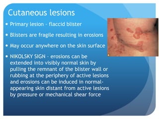 Cutaneous lesions
 Primary lesion – flaccid blister
 Blisters are fragile resulting in erosions
 May occur anywhere on the skin surface
 NIKOLSKY SIGN – erosions can be
extended into visibly normal skin by
pulling the remnant of the blister wall or
rubbing at the periphery of active lesions
and erosions can be induced in normal-
appearing skin distant from active lesions
by pressure or mechanical shear force
 