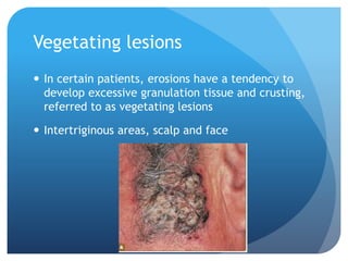 Vegetating lesions
 In certain patients, erosions have a tendency to
develop excessive granulation tissue and crusting,
referred to as vegetating lesions
 Intertriginous areas, scalp and face
 
