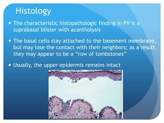 Histology
 The characteristic histopathologic finding in PV is a
suprabasal blister with acantholysis
 The basal cells stay attached to the basement membrane,
but may lose the contact with their neighbors; as a result,
they may appear to be a “row of tombstones”
 Usually, the upper epidermis remains intact
 
