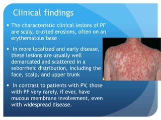 Clinical findings
 The characteristic clinical lesions of PF
are scaly, crusted erosions, often on an
erythematous base
 In more localized and early disease,
these lesions are usually well
demarcated and scattered in a
seborrheic distribution, including the
face, scalp, and upper trunk
 In contrast to patients with PV, those
with PF very rarely, if ever, have
mucous membrane involvement, even
with widespread disease.
 