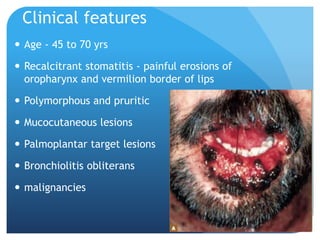 Clinical features
 Age - 45 to 70 yrs
 Recalcitrant stomatitis - painful erosions of
oropharynx and vermilion border of lips
 Polymorphous and pruritic
 Mucocutaneous lesions
 Palmoplantar target lesions
 Bronchiolitis obliterans
 malignancies
 