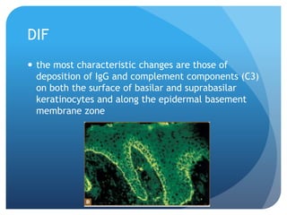 DIF
 the most characteristic changes are those of
deposition of IgG and complement components (C3)
on both the surface of basilar and suprabasilar
keratinocytes and along the epidermal basement
membrane zone
 