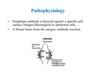 Pemphigus