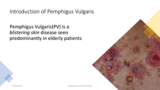 Introduction of Pemphigus Vulgaris
Pemphigus Vulgaris(PV) is a
blistering skin disease seen
predominantly in elderly patients
23/05/2020 Pemphigus (Dr Akshay Shetty) 4
 