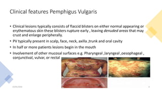 Clinical features Pemphigus Vulgaris
• Clinical lesions typically consists of flaccid blisters on either normal appearing or
erythematous skin these blisters rupture early , leaving denuded areas that may
crust and enlarge peripherally.
• PV typically present in scalp, face, neck, axilla ,trunk and oral cavity
• In half or more patients lesions begin in the mouth
• Involvement of other mucosal surfaces e.g. Pharyngeal ,laryngeal ,oesophageal ,
conjunctival, vulvar, or rectal
23/05/2020 Pemphigus (Dr Akshay Shetty) 6
 