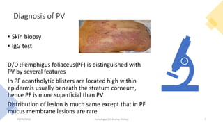 Diagnosis of PV
• Skin biopsy
• IgG test
D/D :Pemphigus foliaceus(PF) is distinguished with
PV by several features
In PF acantholytic blisters are located high within
epidermis usually beneath the stratum corneum,
hence PF is more superficial than PV
Distribution of lesion is much same except that in PF
mucus membrane lesions are rare
23/05/2020 Pemphigus (Dr Akshay Shetty) 7
 
