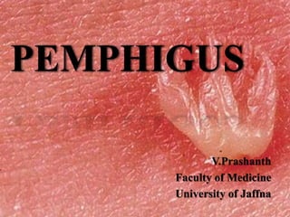 PEMPHIGUS
V.Prashanth
Faculty of Medicine
University of Jaffna
 