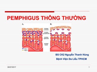 PEMPHIGUS THÔNG THƯỜNG
BS CK2 Nguyễn Thanh Hùng
Bệnh Viện Da Liễu TPHCM
130/07/2017
 