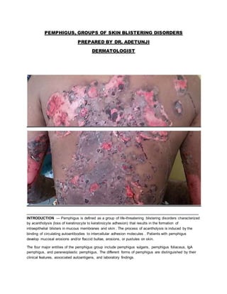 PEMPHIGUS, GROUPS OF SKIN BLISTERING DISORDERS
PREPARED BY DR. ADETUNJI
DERMATOLOGIST
____________________________________________________________________________________
INTRODUCTION — Pemphigus is defined as a group of life-threatening blistering disorders characterized
by acantholysis (loss of keratinocyte to keratinocyte adhesion) that results in the formation of
intraepithelial blisters in mucous membranes and skin . The process of acantholysis is induced by the
binding of circulating autoantibodies to intercellular adhesion molecules . Patients with pemphigus
develop mucosal erosions and/or flaccid bullae, erosions, or pustules on skin.
The four major entities of the pemphigus group include pemphigus vulgaris, pemphigus foliaceus, IgA
pemphigus, and paraneoplastic pemphigus. The different forms of pemphigus are distinguished by their
clinical features, associated autoantigens, and laboratory findings.
 