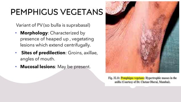 PEMPHIGUS | PDF