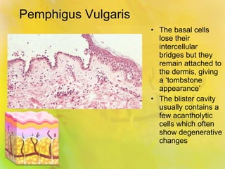 Pemphigus Vulgaris The basal cells lose their intercellular bridges but they remain attached to the dermis, giving a ‘tombstone appearance’ The blister cavity usually contains a few acantholytic cells which often show degenerative changes 
