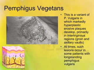 Pemphigus Vegetans This is a variant of P. Vulgaris in which markedly hyperplastic erosive plaques develop, primarily in intertriginous regions (groin and axillary vaults) At times, such lesions occur in some patients with longstanding pemphigus vulgaris 