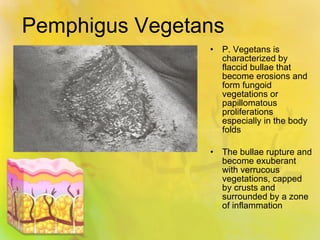 Pemphigus Vegetans P. Vegetans is characterized by flaccid bullae that become erosions and form fungoid vegetations or papillomatous proliferations especially in the body folds The bullae rupture and become exuberant with verrucous vegetations, capped by crusts and surrounded by a zone of inflammation 