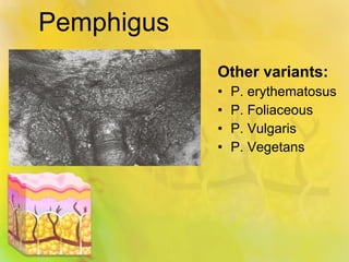 Pemphigus  Other variants: P. erythematosus P. Foliaceous P. Vulgaris P. Vegetans 