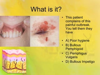 What is it? This patient complains of this painful outbreak.  You tell them they have A) Poor hygiene B) Bullous Pemphigoid C) Pemphigus Vulgaris D) Bullous Impetigo 