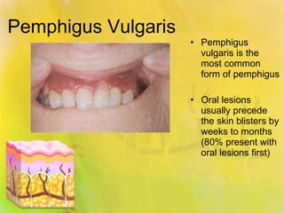 Pemphigus Vulgaris Pemphigus vulgaris is the most common form of pemphigus Oral lesions usually precede the skin blisters by weeks to months (80% present with oral lesions first) 