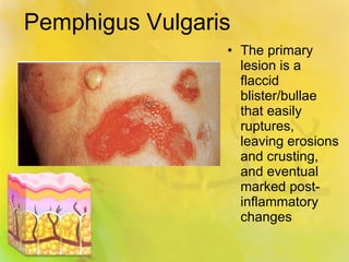 Pemphigus Vulgaris The primary lesion is a flaccid blister/bullae that easily ruptures, leaving erosions and crusting, and eventual marked post-inflammatory changes 