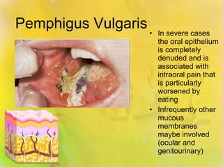 Pemphigus Vulgaris In severe cases the oral epithelium is completely denuded and is associated with intraoral pain that is particularly worsened by eating Infrequently other mucous membranes maybe involved (ocular and genitourinary) 