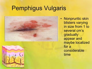 Pemphigus Vulgaris Nonpruritic skin blisters varying in size from 1 to several cm’s gradually appear and maybe localized for a considerable time 