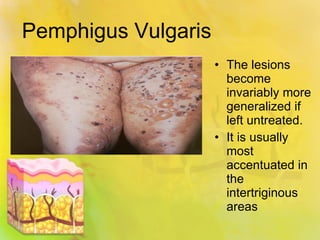 Pemphigus Vulgaris The lesions become invariably more generalized if left untreated. It is usually most accentuated in the intertriginous areas 
