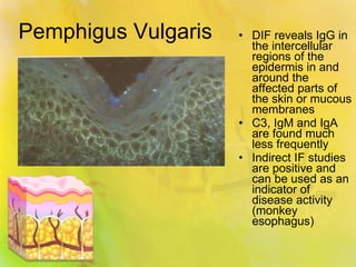 Pemphigus Vulgaris DIF reveals IgG in the intercellular regions of the epidermis in and around the affected parts of the skin or mucous membranes C3, IgM and IgA are found much less frequently Indirect IF studies are positive and can be used as an indicator of disease activity (monkey esophagus) 
