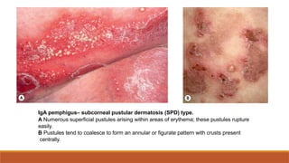 pemphigus Vulgaris .presentation ,dermatology | PPTX