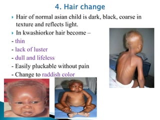  Hair of normal asian child is dark, black, coarse in
texture and reflects light.
 In kwashiorkor hair become –
- thin
- lack of luster
- dull and lifeless
- Easily pluckable without pain
- Change to raddish color
 