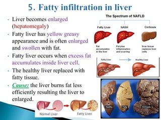 • Liver becomes enlarged
(hepatomegaly)
• Fatty liver has yellow greasy
appearance and is often enlarged
and swollen with fat.
• Fatty liver occurs when excess fat
accumulates inside liver cell.
• The healthy liver replaced with
fatty tissue.
• Cause: the liver burns fat less
efficiently resulting the liver to
enlarged.
 