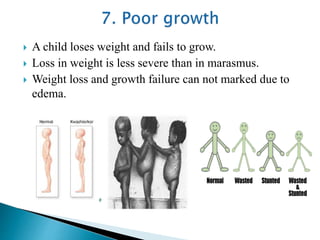  A child loses weight and fails to grow.
 Loss in weight is less severe than in marasmus.
 Weight loss and growth failure can not marked due to
edema.
 