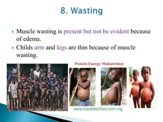  Muscle wasting is present but not be evident because
of edema.
 Childs arm and legs are thin because of muscle
wasting.
 