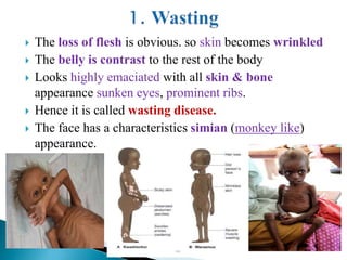  The loss of flesh is obvious. so skin becomes wrinkled
 The belly is contrast to the rest of the body
 Looks highly emaciated with all skin & bone
appearance sunken eyes, prominent ribs.
 Hence it is called wasting disease.
 The face has a characteristics simian (monkey like)
appearance.
 