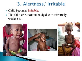  Child becomes irritable.
 The child cries continuously due to extremely
weakness.
 