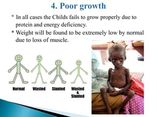 * In all cases the Childs fails to grow properly due to
protein and energy deficiency.
* Weight will be found to be extremely low by normal
due to loss of muscle.
 