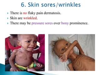  There is no flaky pain dermatosis.
 Skin are wrinkled.
 There may be pressure sores over bony prominence.
 