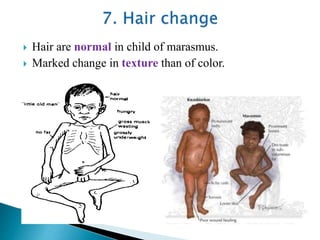  Hair are normal in child of marasmus.
 Marked change in texture than of color.
 