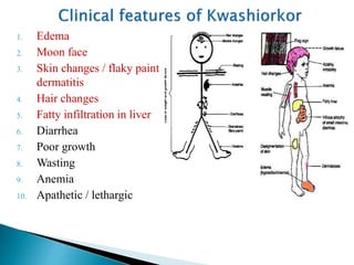 1. Edema
2. Moon face
3. Skin changes / flaky paint
dermatitis
4. Hair changes
5. Fatty infiltration in liver
6. Diarrhea
7. Poor growth
8. Wasting
9. Anemia
10. Apathetic / lethargic
 