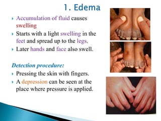  Accumulation of fluid causes
swelling
 Starts with a light swelling in the
feet and spread up to the legs.
 Later hands and face also swell.
Detection procedure:
 Pressing the skin with fingers.
 A depression can be seen at the
place where pressure is applied.
 