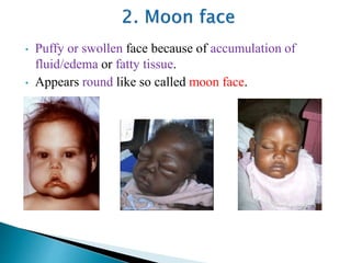 • Puffy or swollen face because of accumulation of
fluid/edema or fatty tissue.
• Appears round like so called moon face.
 