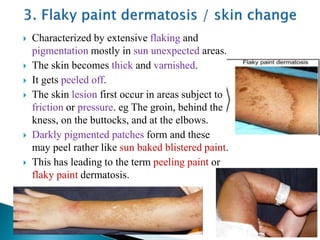 Characterized by extensive flaking and
pigmentation mostly in sun unexpected areas.
 The skin becomes thick and varnished.
 It gets peeled off.
 The skin lesion first occur in areas subject to
friction or pressure. eg The groin, behind the
kness, on the buttocks, and at the elbows.
 Darkly pigmented patches form and these
may peel rather like sun baked blistered paint.
 This has leading to the term peeling paint or
flaky paint dermatosis.
 