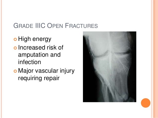 penanganan terkini patah tulang terbuka open fracture 35 638