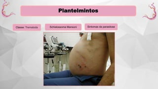 Plantelmintos
Classe: Trematoda Schistossoma Mansoni Sintomas da parasitose
 