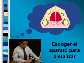 Escoger el
aparato para
distalizar

 
